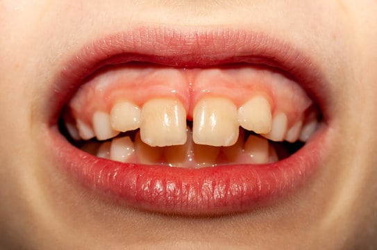 Understanding Protrusion Teeth - Types, Symptoms, and Treatment Options